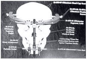 Distractor rígido externo KLS Martín