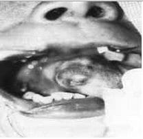 Isquemia Inicial, Malformaciones Arteriovenosas