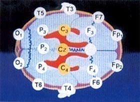 línea sutura frontonasal