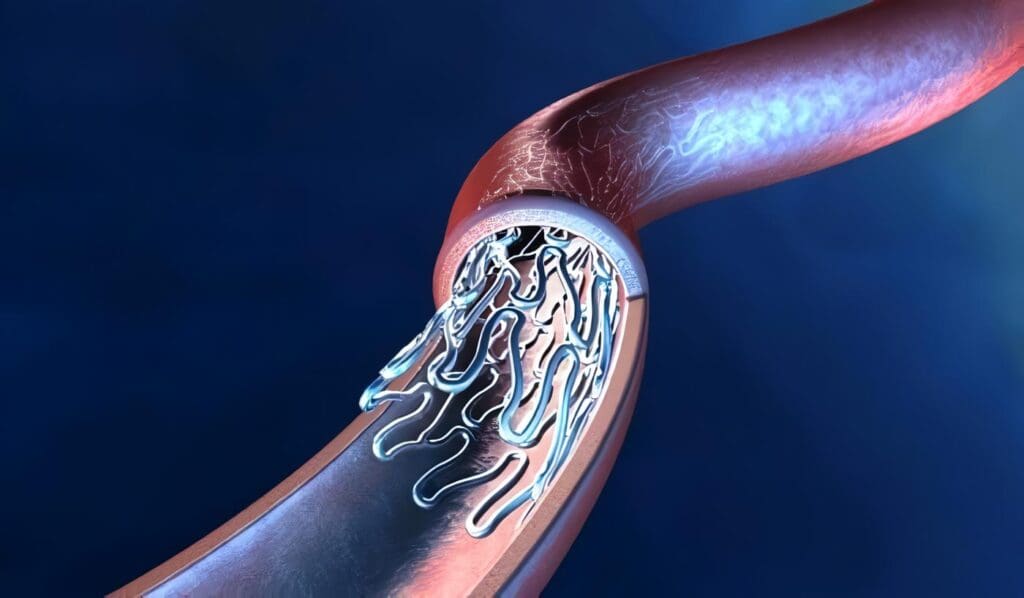 Endoprótesis Biodegradable resulta Exitosa en Ensayo con Humanos
