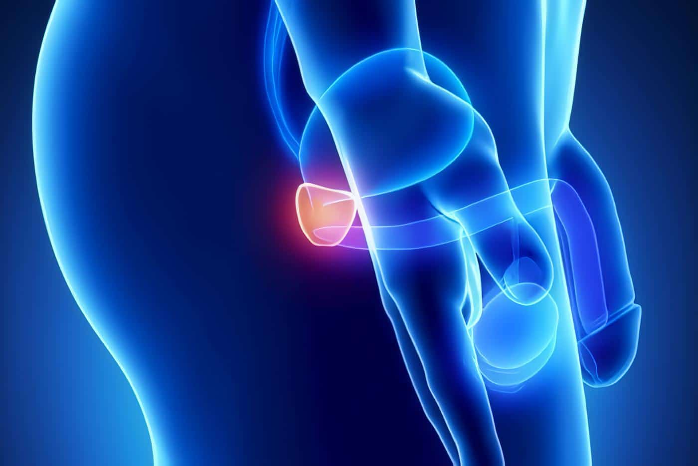 Genes Fusionados podrían suscitar los Tumores de Próstata