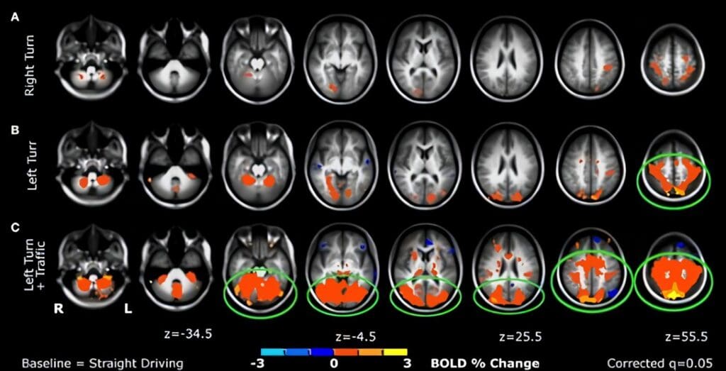 Cierta Lesión de Rodilla estaría ligada a Alteración Cerebral