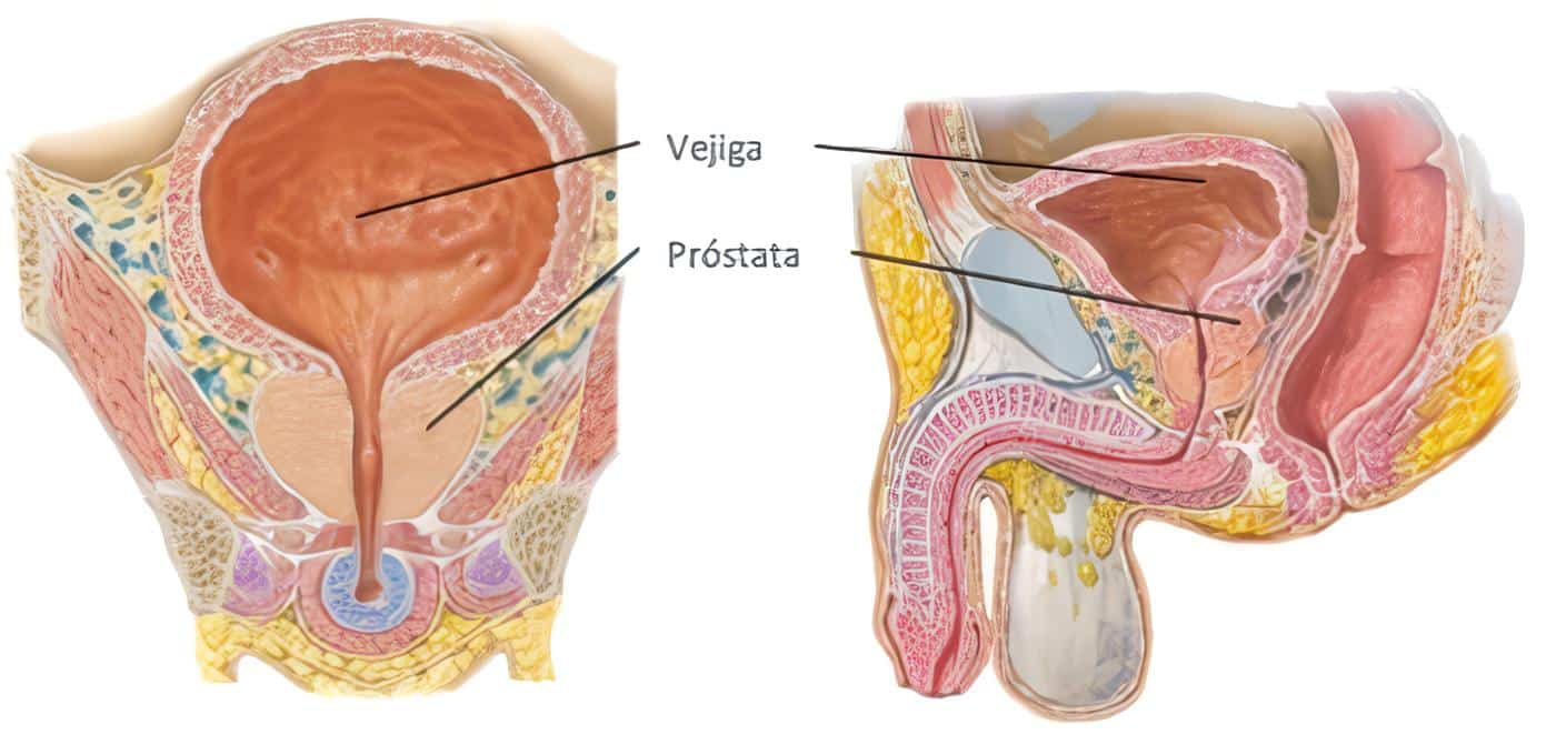 Métodos Quirúrgicos de Próstata