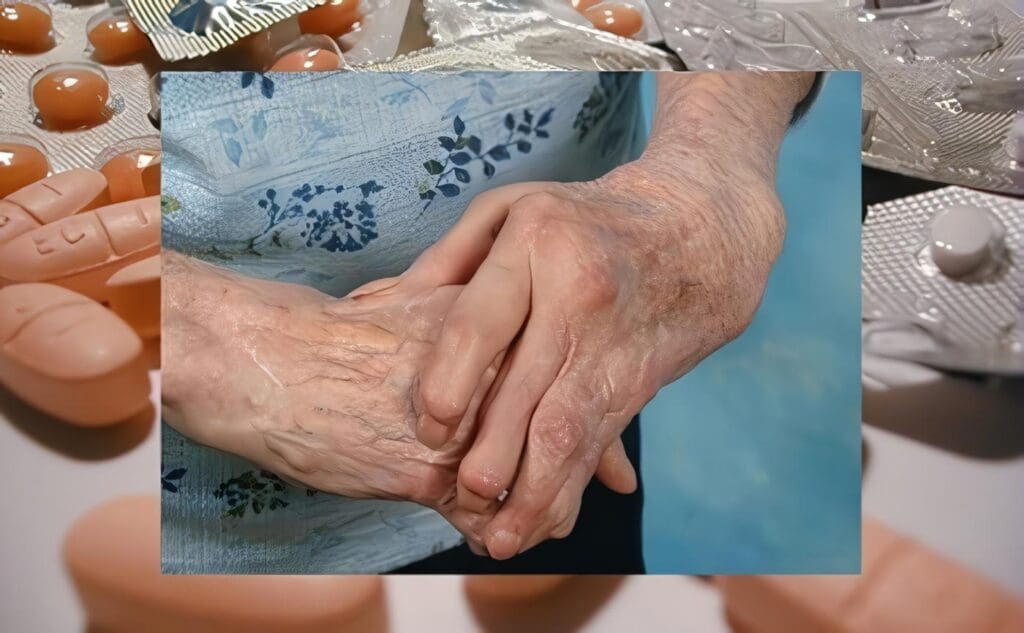 Tratamiento Artritis Reumatoide