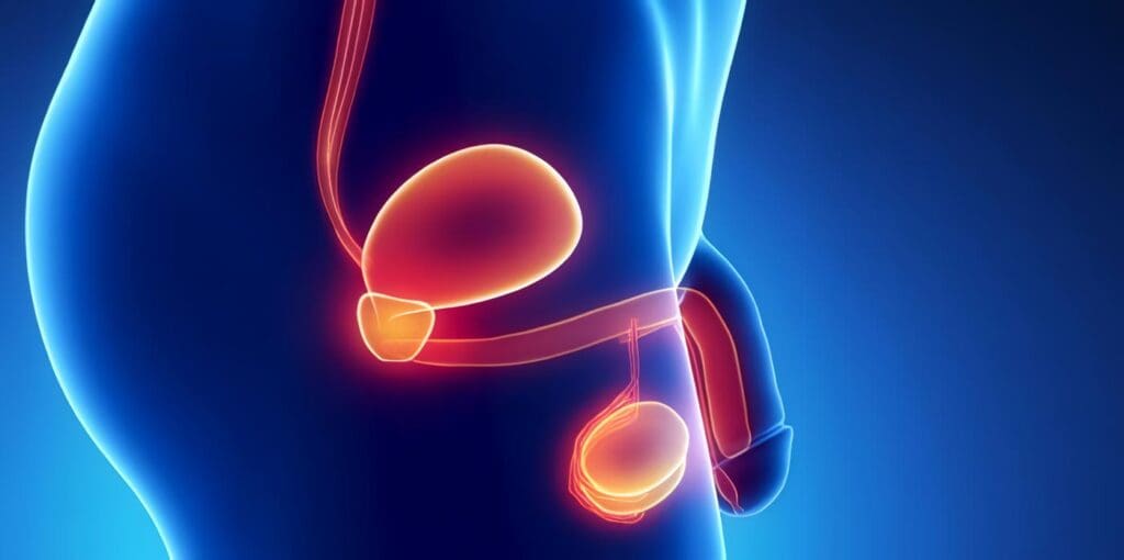Tumor de Próstata