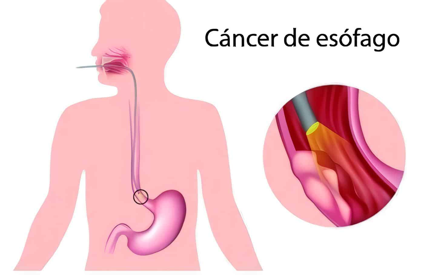 Marcadores Genéticos del Cáncer de Esófago