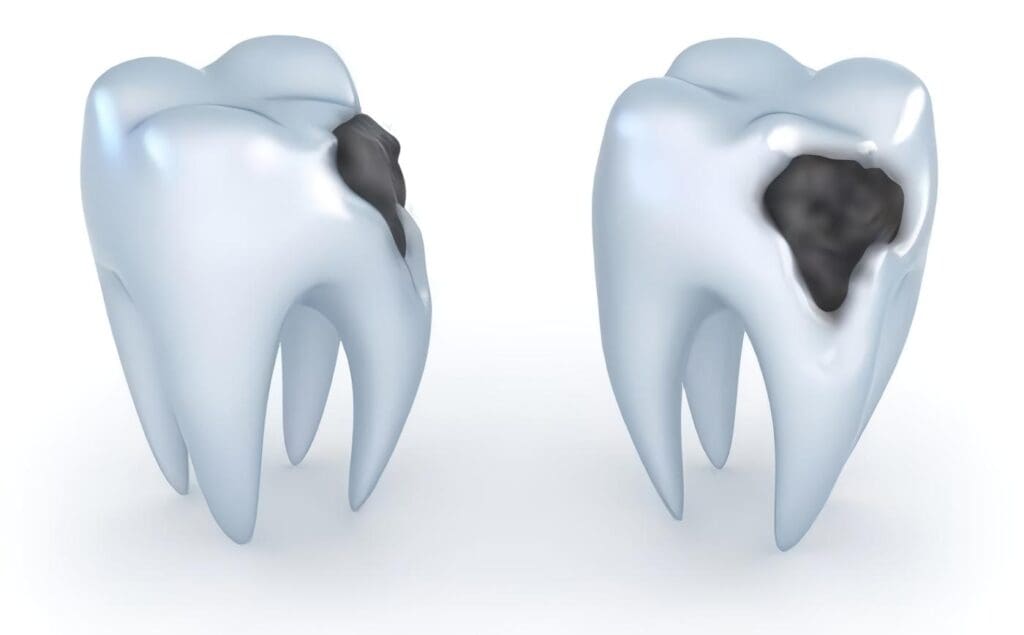 caries-dental y salud oral