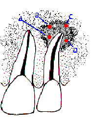 Promedio de color gris de La zona radiolúcida