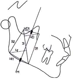 Localización Area del Masetero