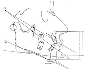 Variación de la altura inferior relacionada al ángulo temporal
