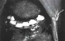 Deformación Intraoral - Marsupializacion de Quistes 