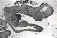 Epitelio Escamoso - Marsupializacion de Quistes