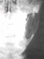 Estructura Dentada - Marsupializacion de Quistes