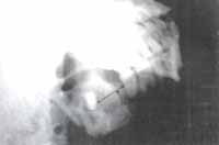 Migración del Tercer Molar - Marsupializacion de Quistes