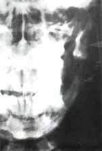 Marsupialización - Marsupializacion de Quistes