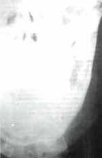 Marsupialización de la Lesión - Marsupializacion de Quistes