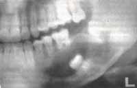 Radiografia Panoramica de Control - Marsupializacion de Quistes