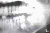 Proceso de Neoformacion Osea - Marsupializacion de Quistes