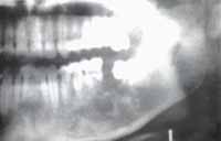 Membrana Quística Residual - Marsupializacion de Quistes