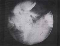 Sinequias (adherencias) entre disco y superficie articular