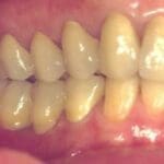 Rehabilitacion-oral-con-enfasis-en-estetica-caso2