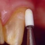 Rehabilitacion-oral-con-enfasis-en-estetica-caso5