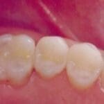 Rehabilitacion-oral-con-enfasis-en-estetica-caso9
