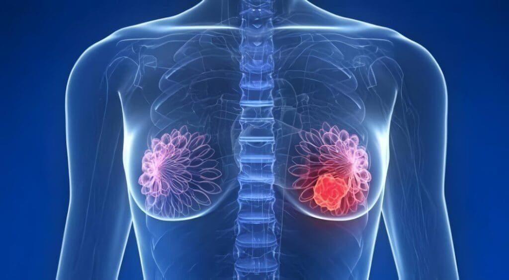 Cáncer Invasivo de Mama