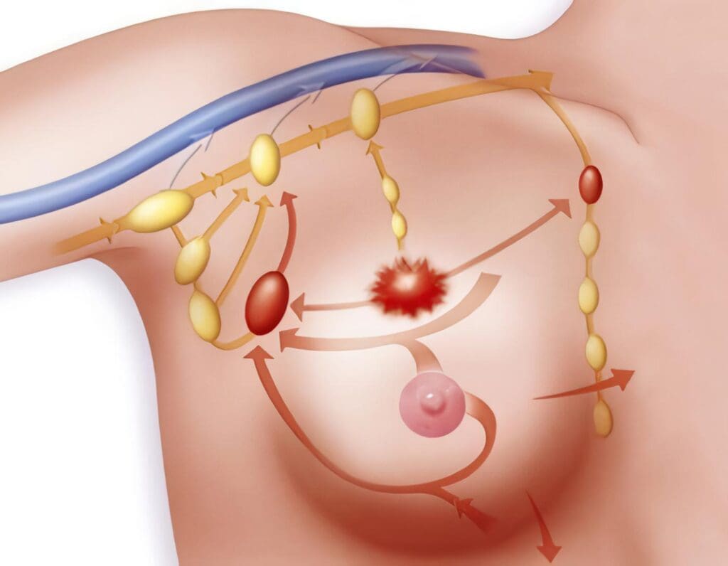 Estudio del Cáncer de Mama