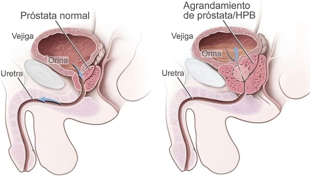 Evaluación del Cáncer de Próstata