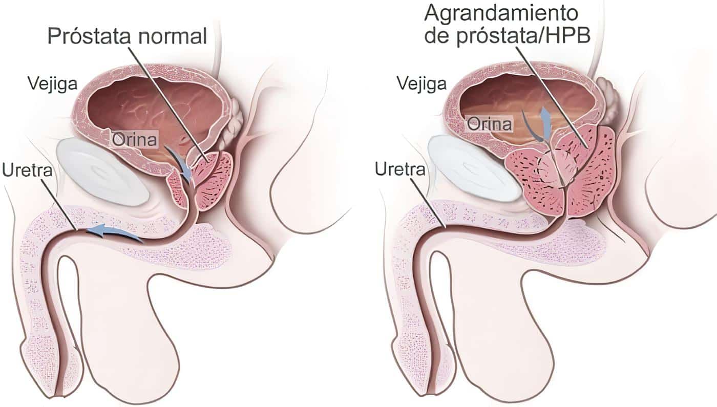 Evaluación del Cáncer de Próstata