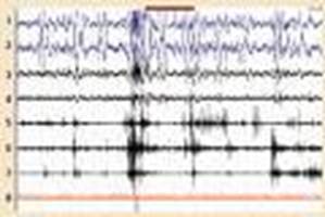 El EEG - patrón de vigilia en la fase REM