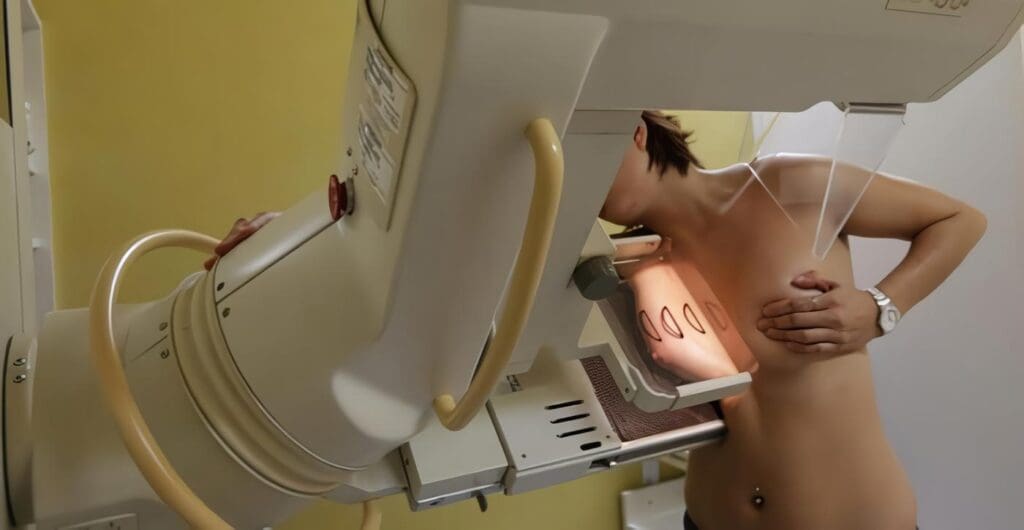 Mamografías Conllevan Más Mastectomías