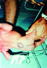 Malformaciones Congénitas