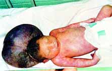 Malformaciones Congénitas cráneo