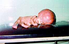 Malformaciones Congénitas en la Sierra Nevada