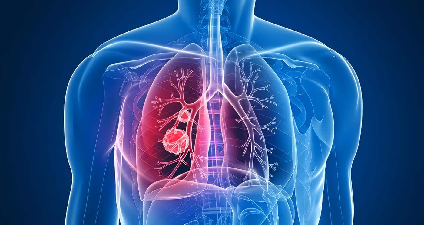 Cáncer de Pulmón