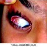 Coristoma ocular