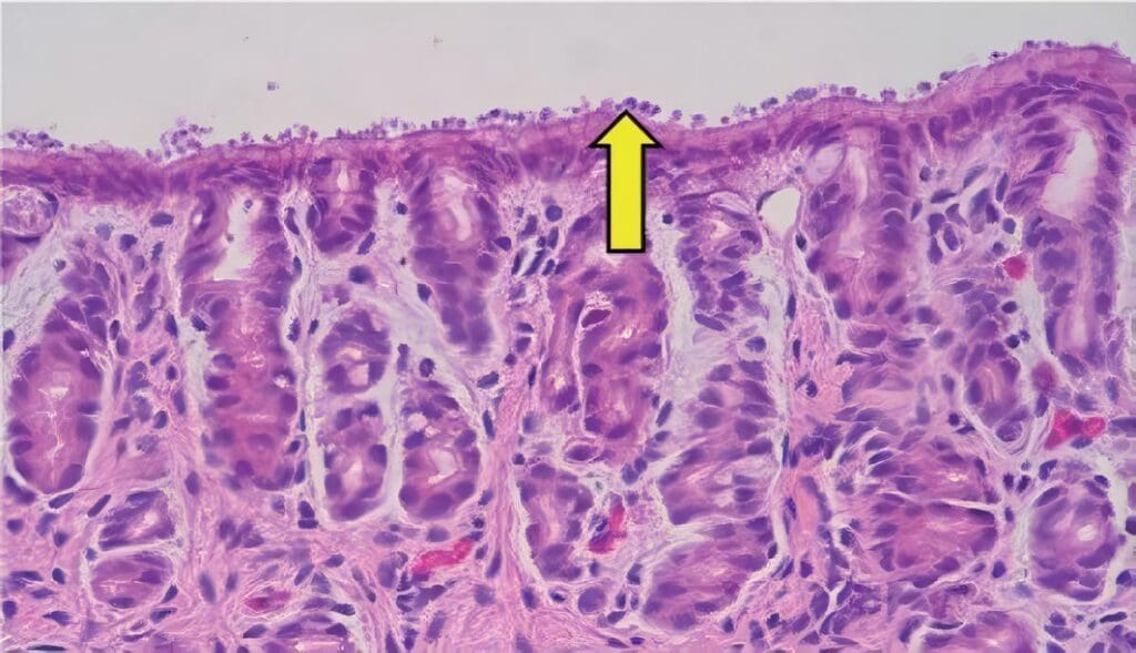 Criptosporidiosis en Niños con Cáncer