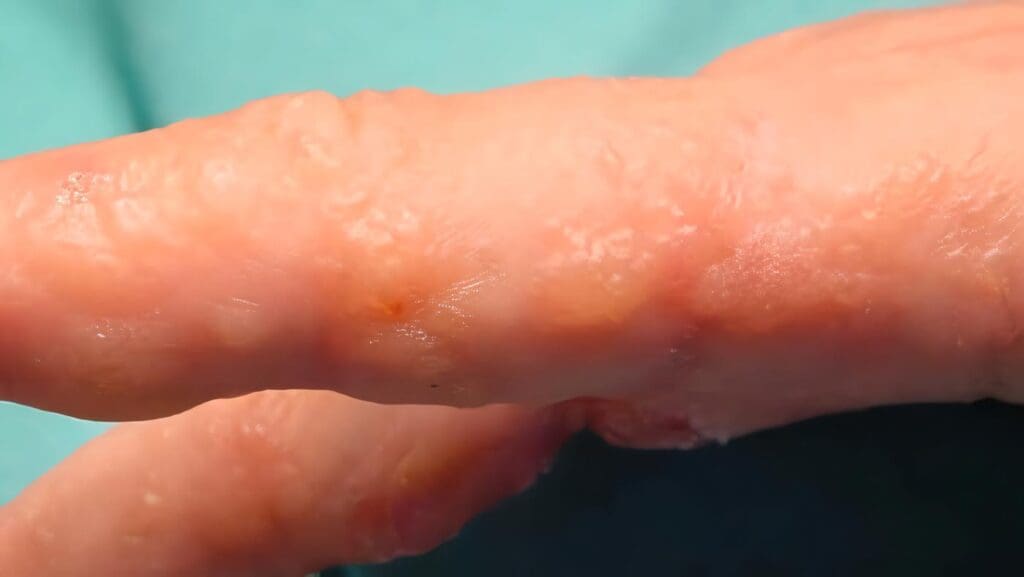 Dermatofitosis