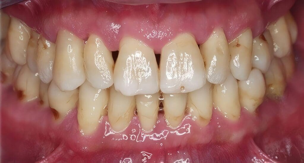 Enfermedad Periodontal