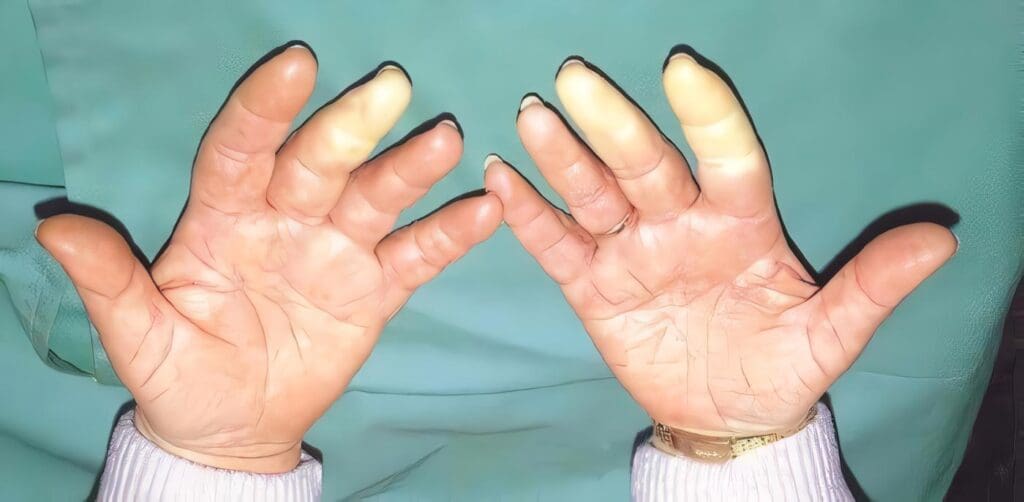 Palidez Palmar