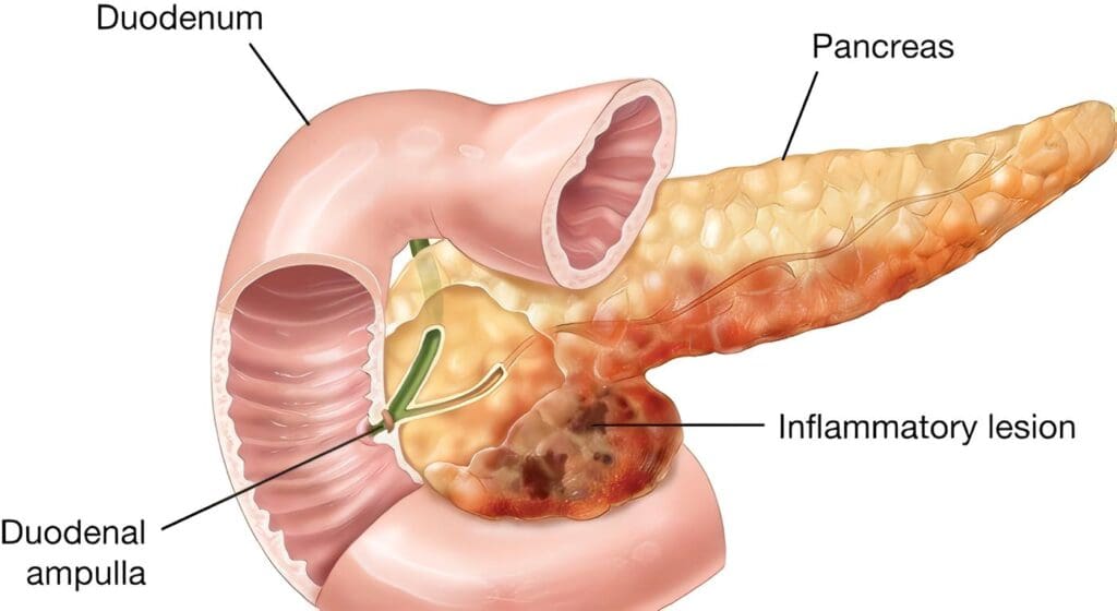 Pancreatitis