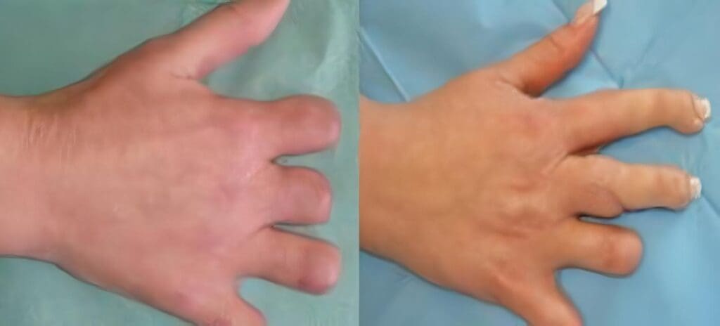 Reimplantes de Miembros