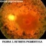 Retinitis pigmentosa