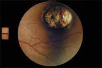 tensiometro-suplementocuatro-fig8