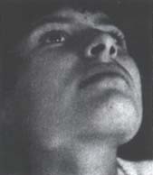 Crecimiento Óseo y Asimetrías Faciales