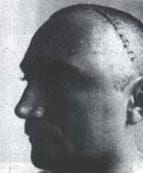 Hemostasia y se sutura la Aponeurosis