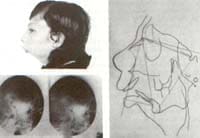 Anquilosis Temporomandibular Bilateral