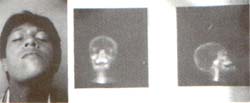 Hiperplasia Hemimandibular